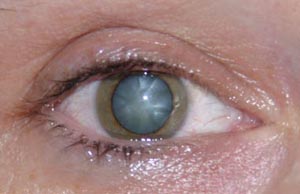 Grauer Star bei weitgetropfter Pupille
