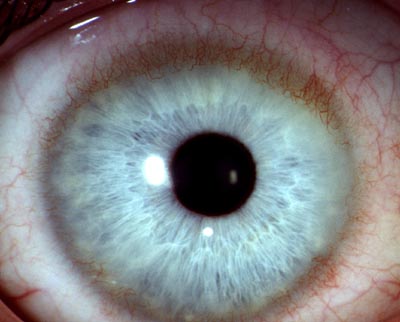 Gefäßeinsprossung durch Kontaktlinsen, leicht (BVA)