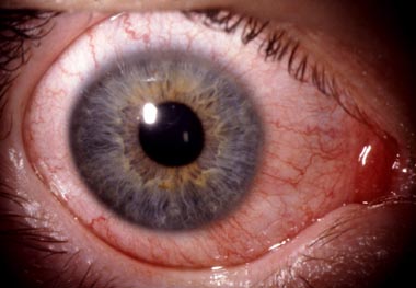 50+ neu Fotos Auge Innen Rot : Gesundheit Tranen Sind Nicht Gleich Tranen Welt : Rote augen können viele ursachen haben: