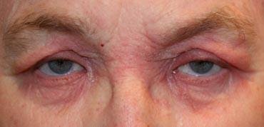 Allergien Auge Online