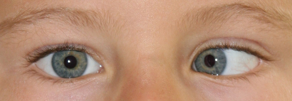 Auge als andere kleiner ein baby das Amblyopie: Symptome,