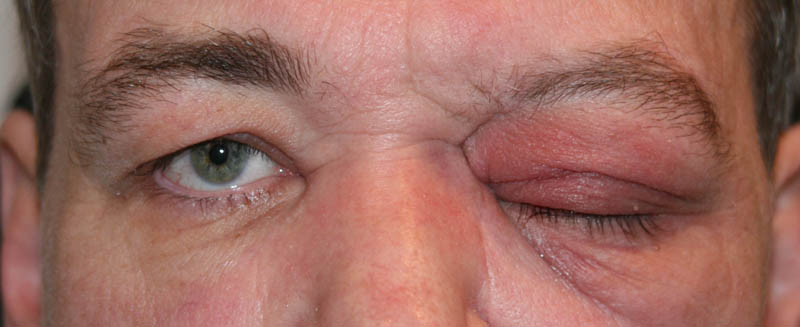 Auge beule im Bullöse Keratopathie